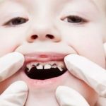 Sâu răng trẻ em: Nguyên nhân và cách phòng tránh, điều trị