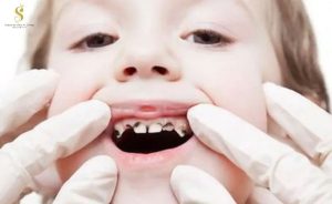 Sâu răng trẻ em: Nguyên nhân và cách phòng tránh, điều trị