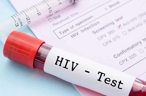 Người bệnh nên tập trung vào điều trị HIV hơn là điều trị sưng hạch