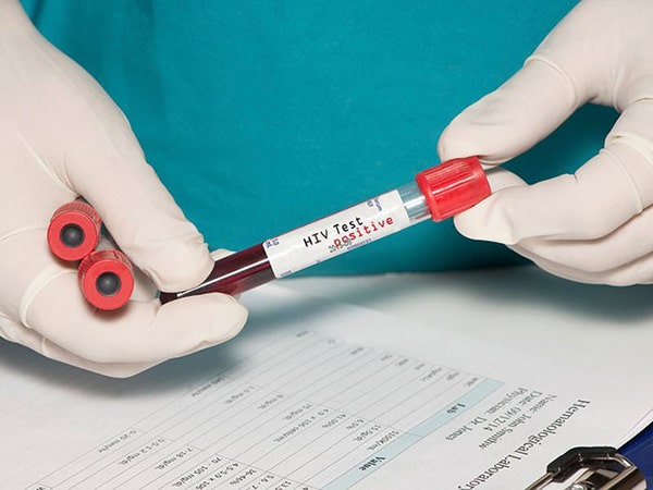 Xét nghiệm acid Nucleic là xét nghiệm đặc hiệu phát hiện HIV nhưng ít đường sử dụng trong sàng lọc cá nhân vì chi phí đắt