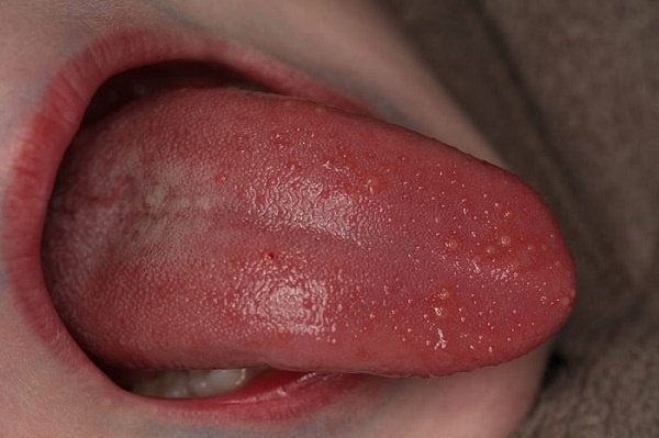 Hình ảnh tổn thương do virus gây u nhú HPV ở lưỡi