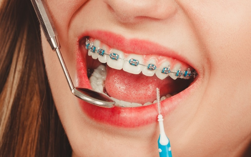Niềng răng mắc cài kim loại mang đến hiệu quả chỉnh nha cao