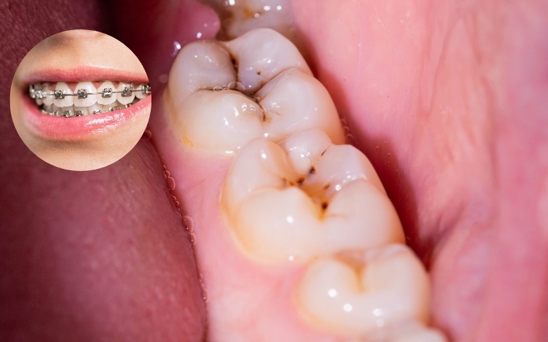 Nhiều bạn đọc thắc mắc sâu răng có niềng được không?