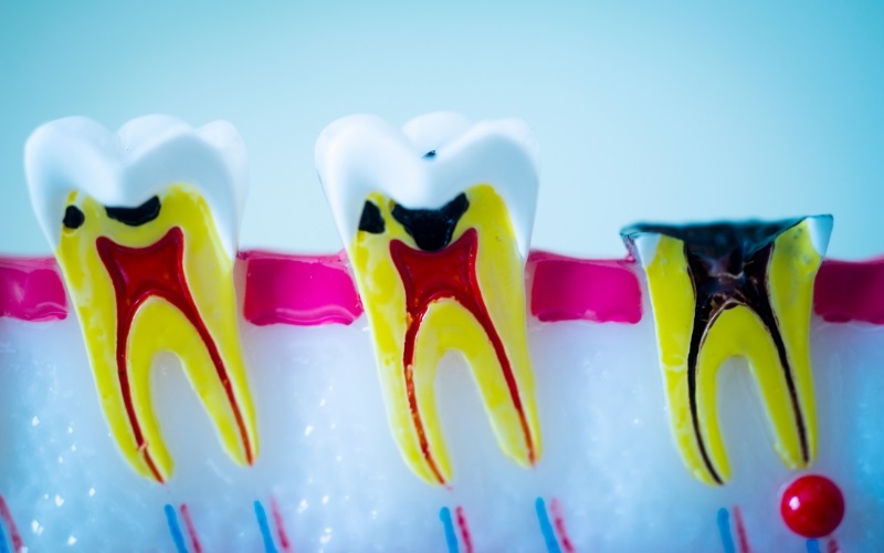Sâu răng là tình trạng mô cứng của răng bị tổn thương