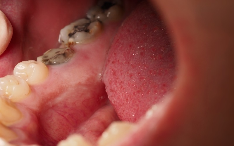 Nếu lỗ sâu lan đến chân răng, bác sĩ sẽ tiến hành nhổ bỏ răng